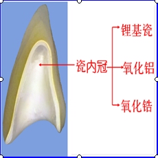 全瓷修復--全瓷的分類(lèi)與發(fā)展