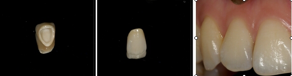 全瓷修復--全瓷的分類(lèi)與發(fā)展